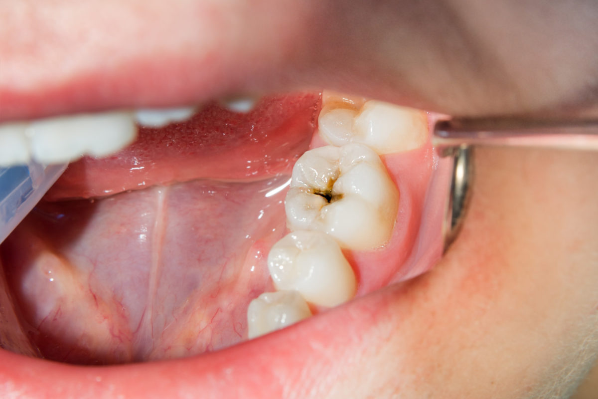 Why People Fear Getting Cavities Cavity Treatments For Adults Willow 