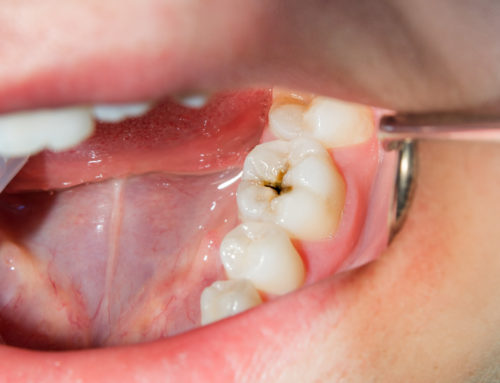 Why People Fear Getting Cavities: Cavity Treatments For Adults